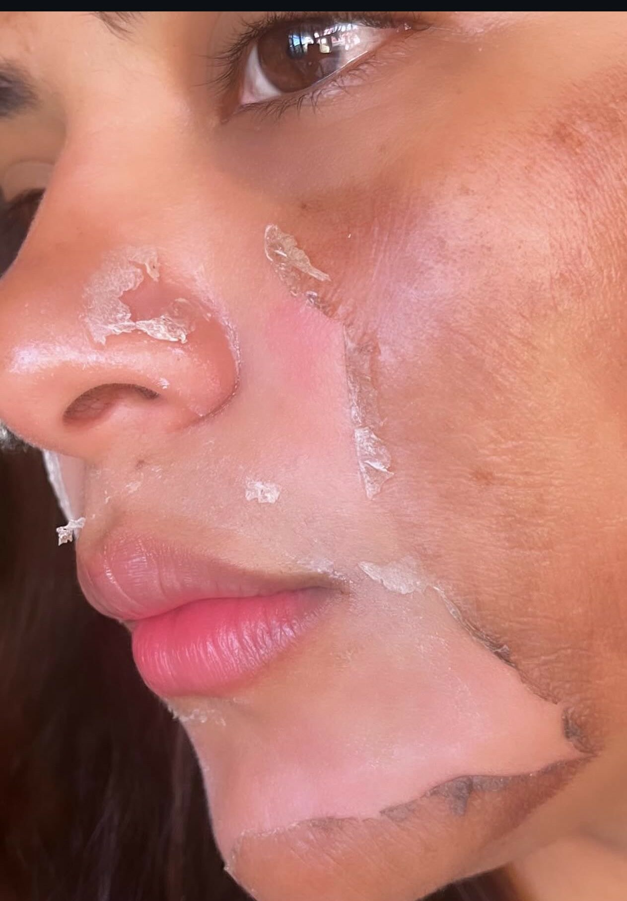 Glymed+ Advanced Chemical Peels